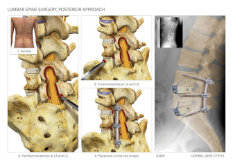 Lumbar Spine Surgery