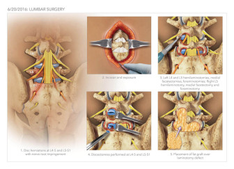 Lumbar Surgery