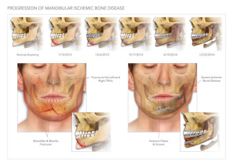 Mandibular Ischemic Bone Disease