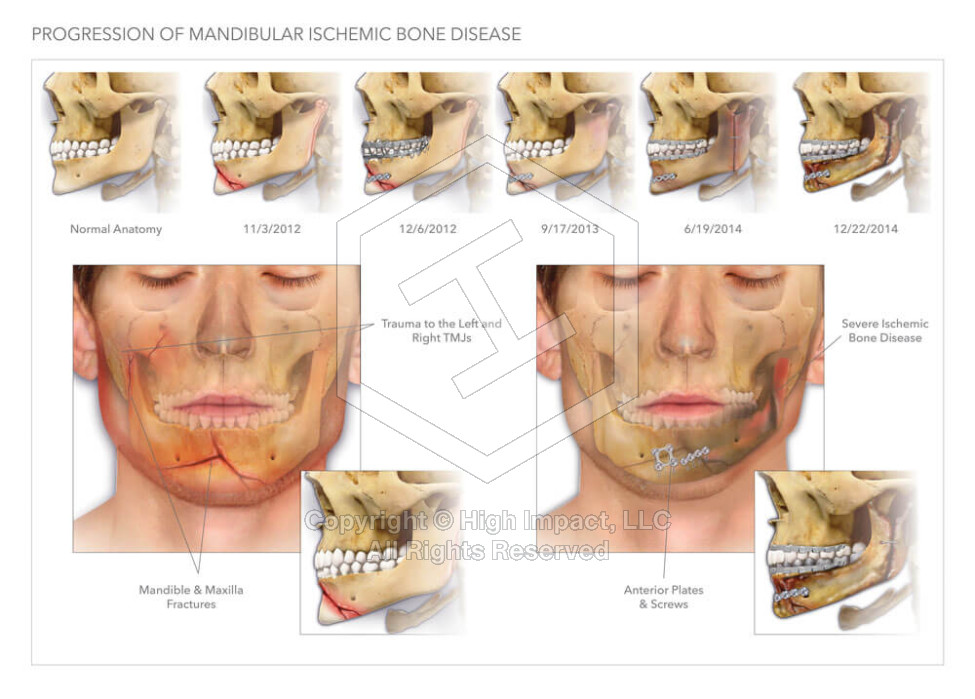 Mandibular Ischemic Bone Disease