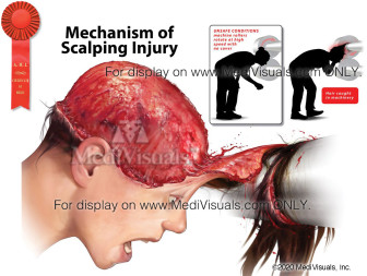 Mechanism of Scalping Injury