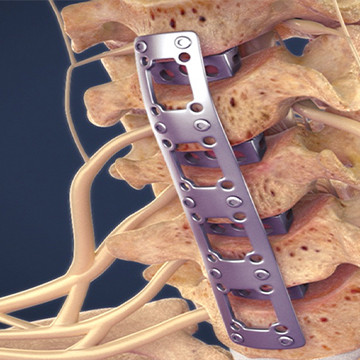 Medical animation still showing anterior cervical discectomy and fusion