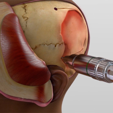Medical illustration showing a craniotomy