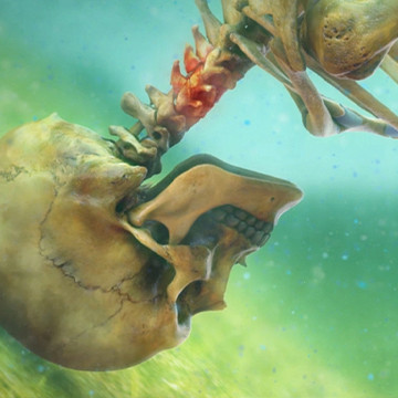 Neck injury from dive into water