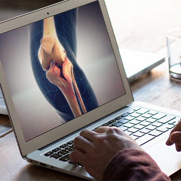 Laptop screen with demonstrative animation showing tibial plateau fracture