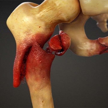 Animated illustration showing severe hip fracture