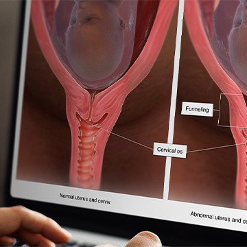 Custom medical legal illustration showing cervical funneling
