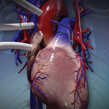 Graphic showing coronary bypass