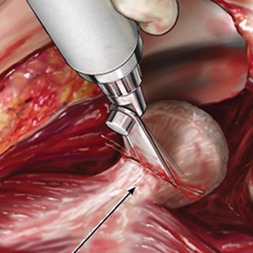 Medical illustration showing hip surgery