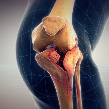 Animation still showing tibial plateau fracture