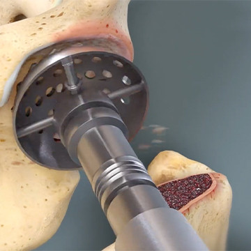 Medical animation showing reaming of the acetabulum
