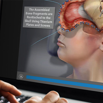 2D animation presentation showing brain surgery