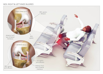 MOI: Right & Left Knee Injuries