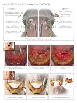 Mouth Reconstruction and Neck Dissection
