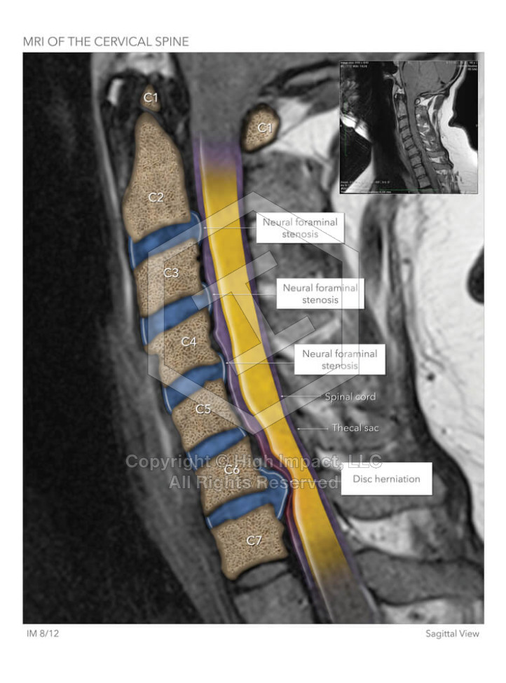 MRI of the Cervical Spine