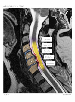 MRI of Cervical Spine