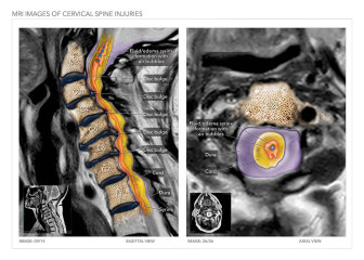 MRI Images of Cervical Spine Injuries