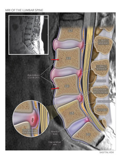 MRI of the Lumbar Spine
