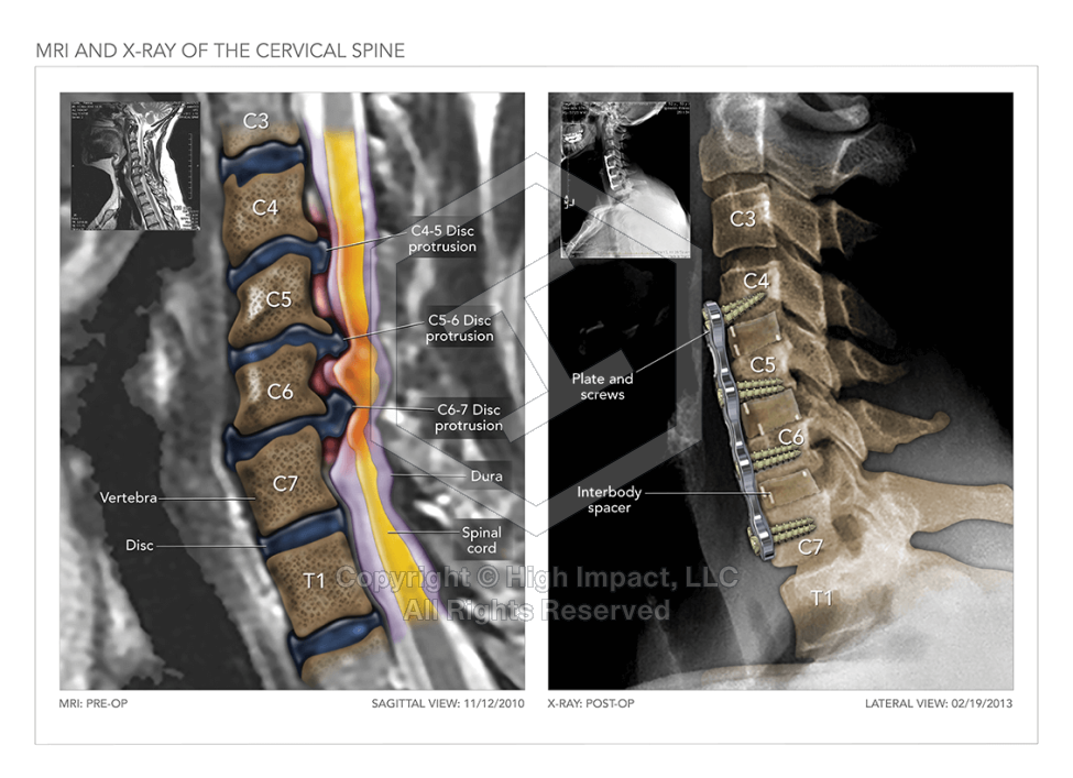 MRI and X-Ray of the Cervical Spine
