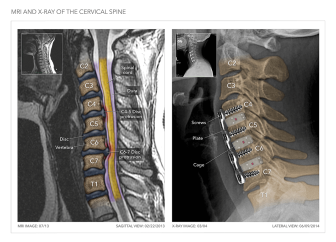 MRI & X-Ray of Cervical Spine