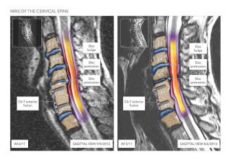 MRIs of the Cervical Spine