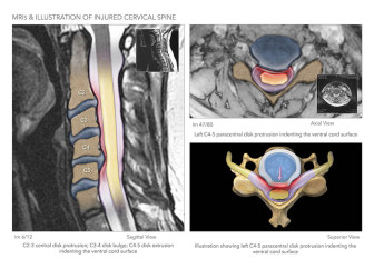 MRIs & Illustration of Injured Cervical Spine