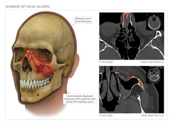 Nasal and Maxillary Sinus Fractures