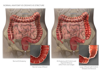 Normal Anatomy Vs. Crohn’s Vs. Stricture