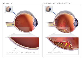 Normal Eye and Injured Eye with Detached Retina
