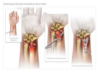 Open Reduction and Fixation of Right Wrist
