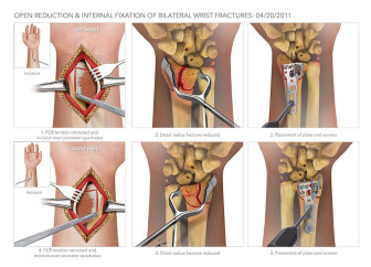 Open Reduction & Internal Fixation of Bilateral Wrist Fractures