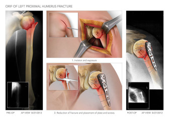 Open Reduction Internal Fixation of Humerus Fracture