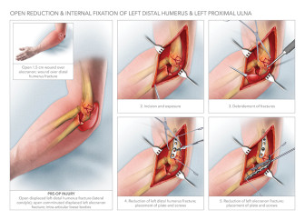 Open Reduction Internal Fixation of Humerus and Ulna