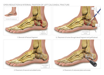 Open Reduction & Internal Fixation of Left Calcaneal Fracture