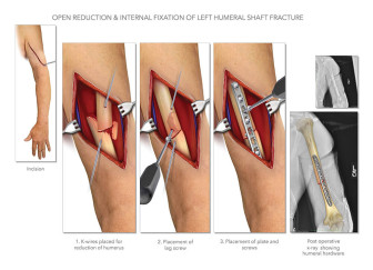 Open Reduction & Internal Fixation of Left Humeral Shaft Fracture
