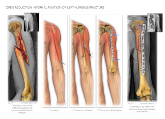 Open Reduction Internal Fixation of Left Humerus Fracture
