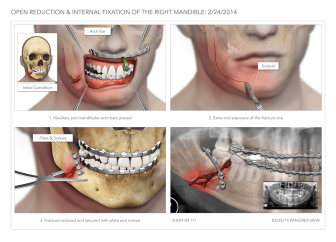 Open Reduction Internal Fixation of Mandible Fracture