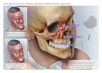 Open Reduction Internal Fixation of Maxillofacial Fractures