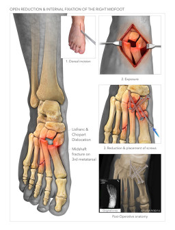 Open Reduction Internal Fixation of the Midfoot