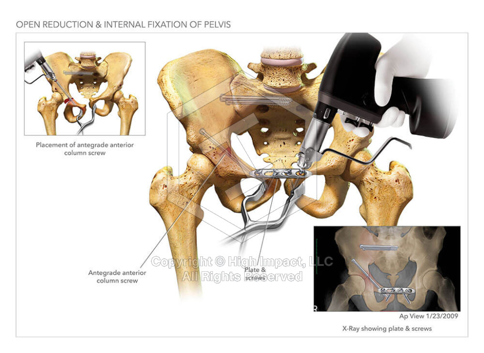 Open Reduction Internal Fixation of Pelvis