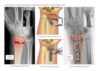 Open Reduction Internal Fixation of Radius Fracture