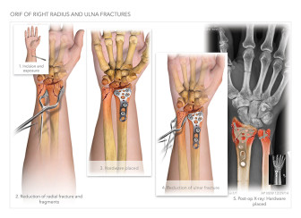 Open Reduction Internal Fixation of Radius and Ulna Fractures