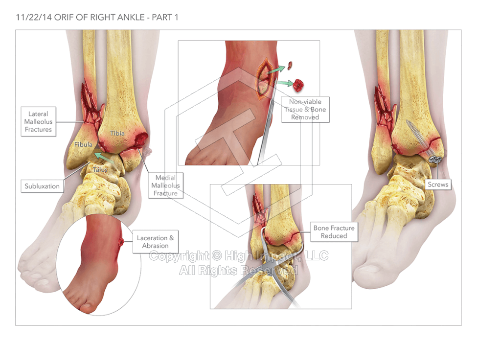 Open Reduction Internal Fixation of the Right Ankle
