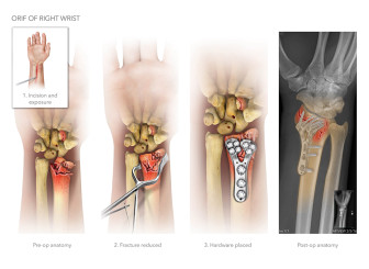 Open Reduction Internal Fixation of the Right Wrist