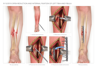 Open Reduction Internal Fixation of the Tibia and Fibula