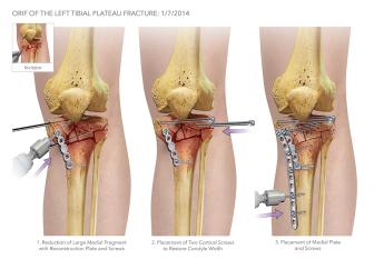 Open Reduction Internal Fixation of the Tibial Plateau Fracture