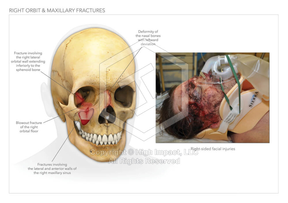 Orbital and Maxillary Fractures