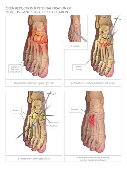 ORIF & Internal Fixation of Right Lisfranc Fracture-Dislocation