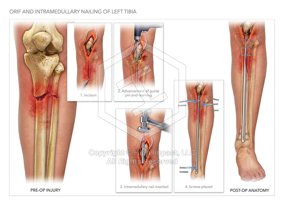 Orif and Intramedullary Nailing of Left Tibia