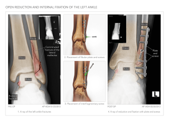 ORIF of The Left Ankle